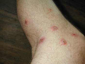 Flea Allergy Dermatitis in Cats and Dogs - Vetstreet